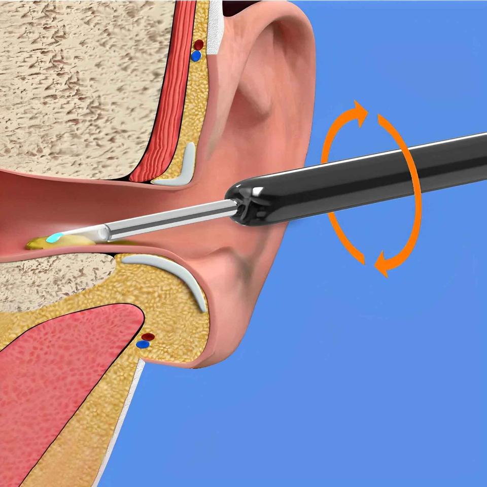 EarBit 3000: Ear Cleaning Tool Featuring Camera Technology